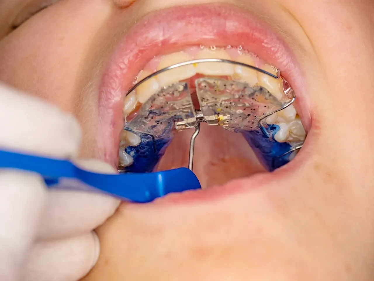 A Parent’s Guide to Palatal Expanders