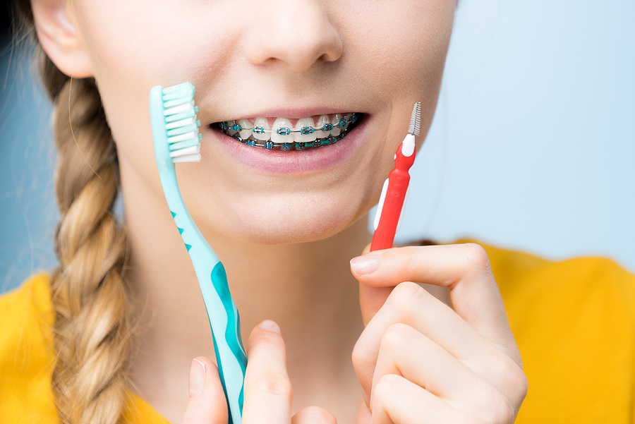 Top Frequently Asked Questions About Braces