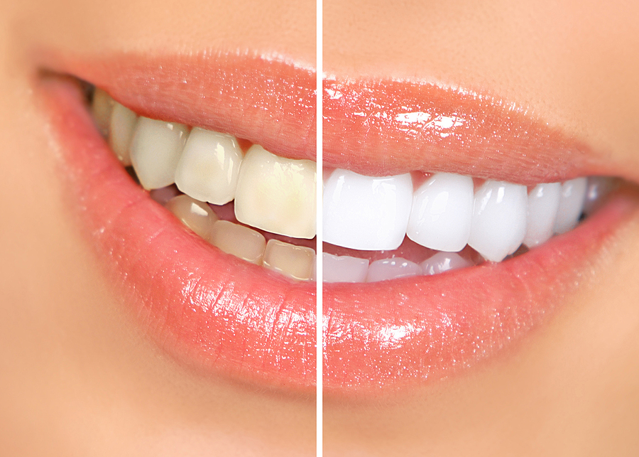 Revitalize Your Smile with Teeth Whitening in Richmond, TX